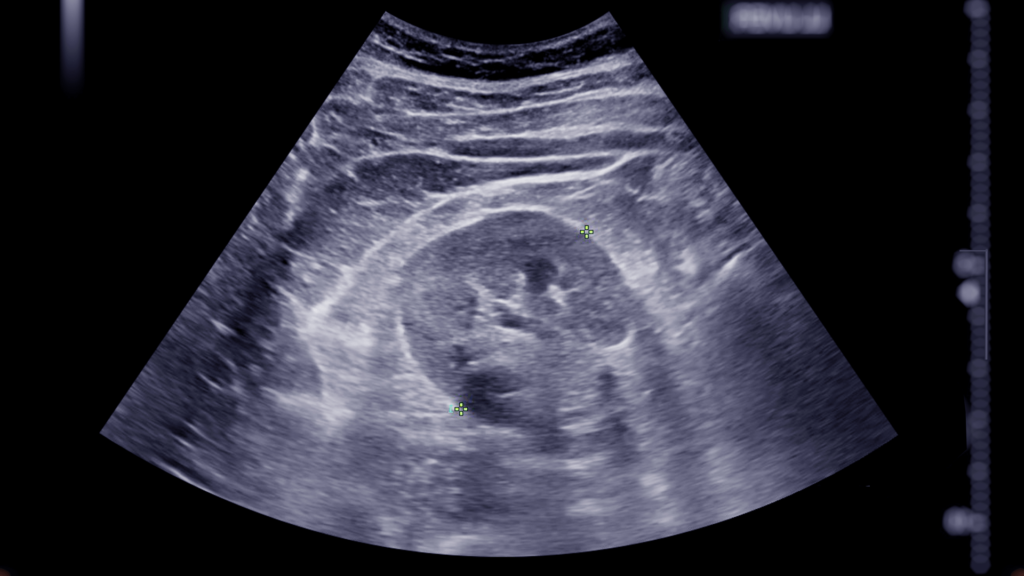 An ultrasound scan of the upper abdomen showing a kidney