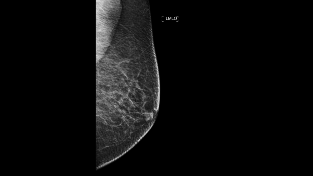 Mammogram showing a benign tumor
