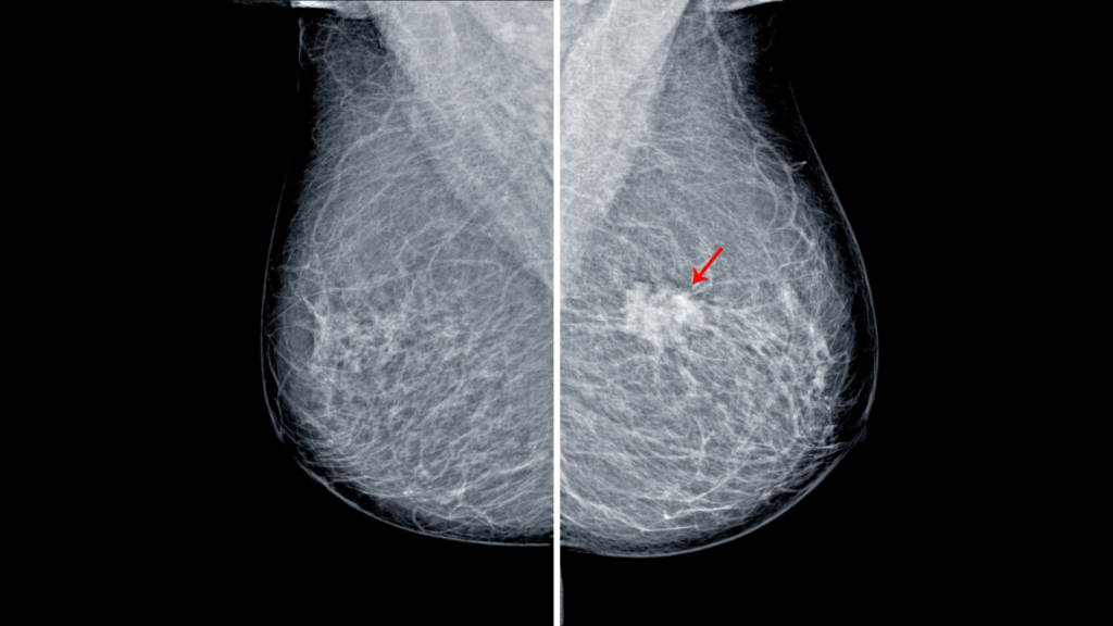 Mammogram showing a malignant calcification on the left breast