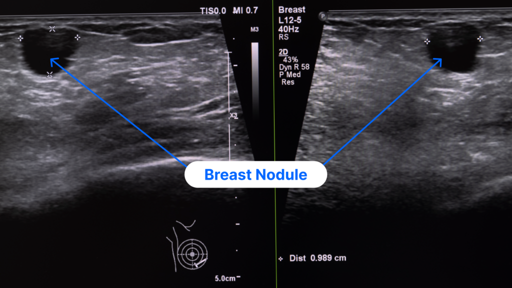 Ultrasound image showing breast nodules
