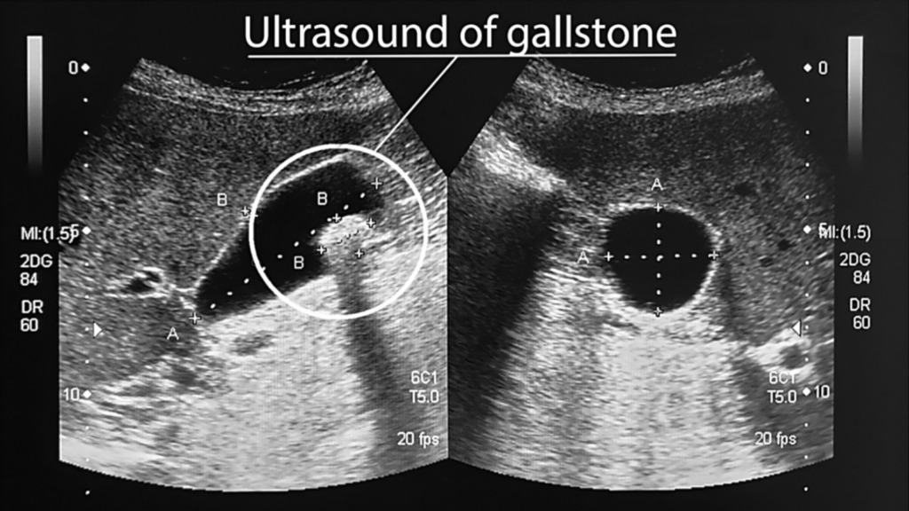 An ultrasound showing gallbladder stones