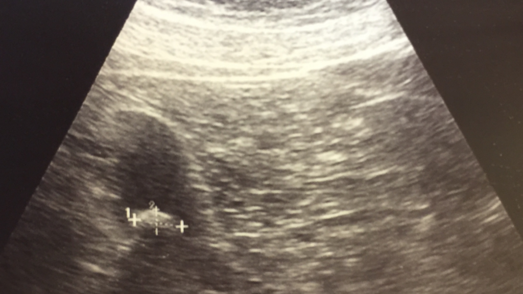 Ultrasound of human liver and gall bladder showing gall bladder stones