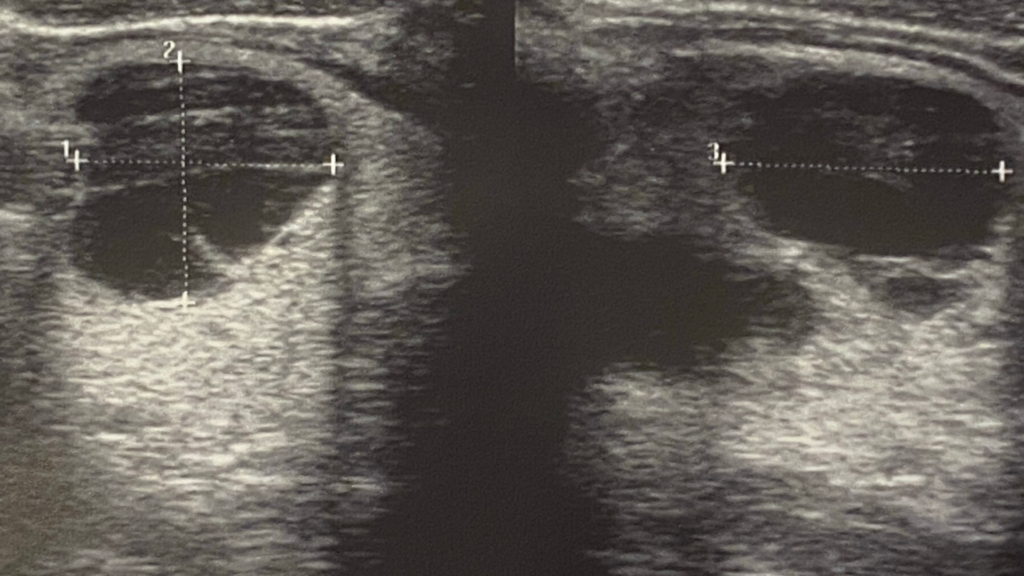 Ultrasound image of cyst in human thyroid gland