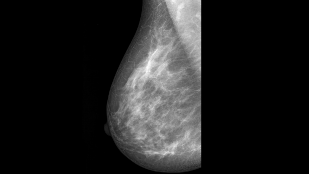 Mammogram showing normal breast tissue