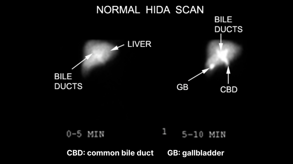 A normal HIDA scan