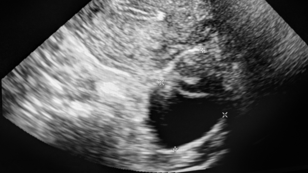 Ultrasound image of an ovarian cyst