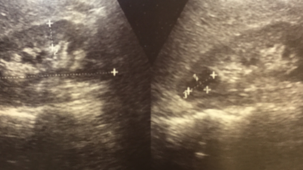Ultrasound of human kidneys with a renal cyst