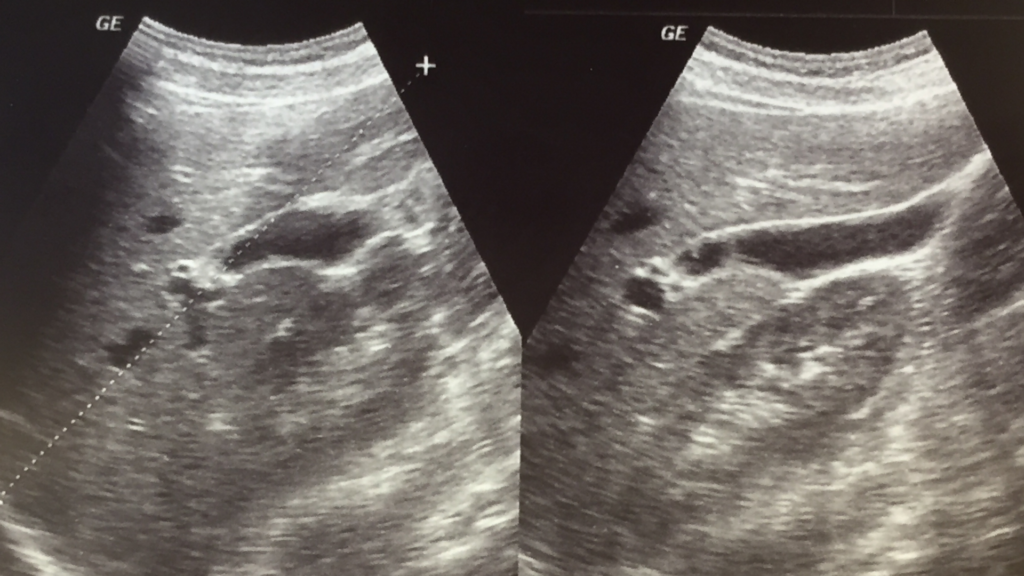 An ultrasound scan of the liver and gallbladder