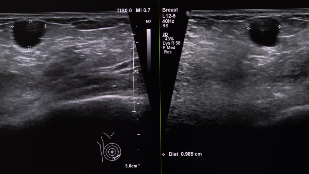 An abnormal breast ultrasound