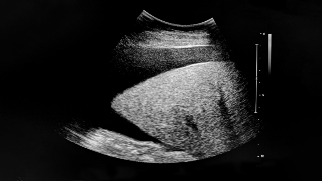 Ultrasound of the liver showing ascites