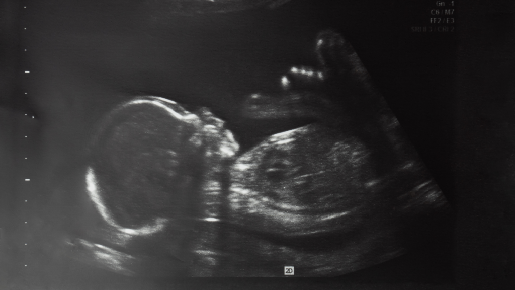 An ultrasound of a 20-week fetus