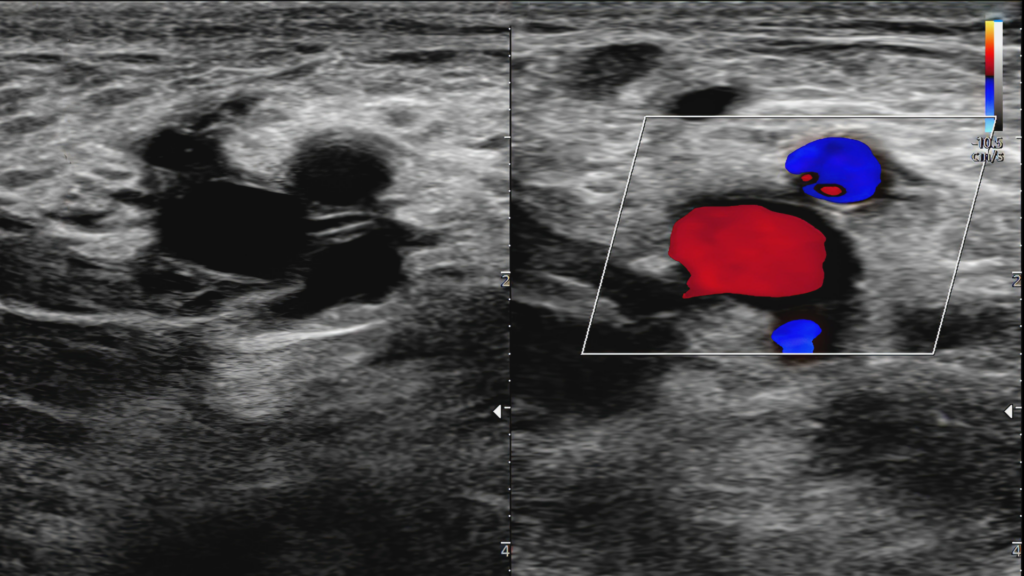 a carotid artery doppler ultrasound