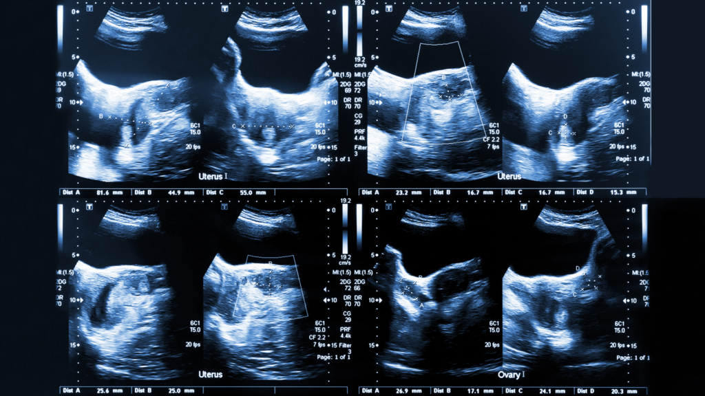 Uterine ultrasound with a possible fibroid growth