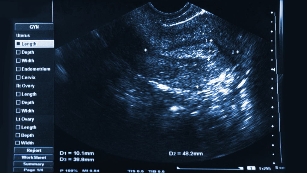Ultrasound of a normal uterus