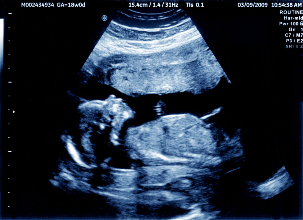 Ultrasound of an 18 week fetus 