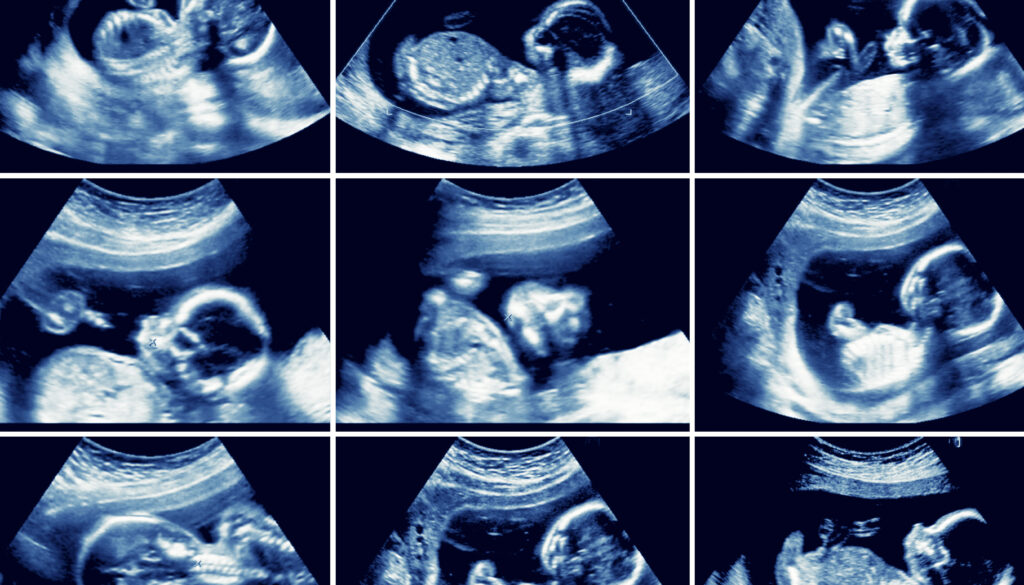 Various ultrasounds of 20 week fetus 