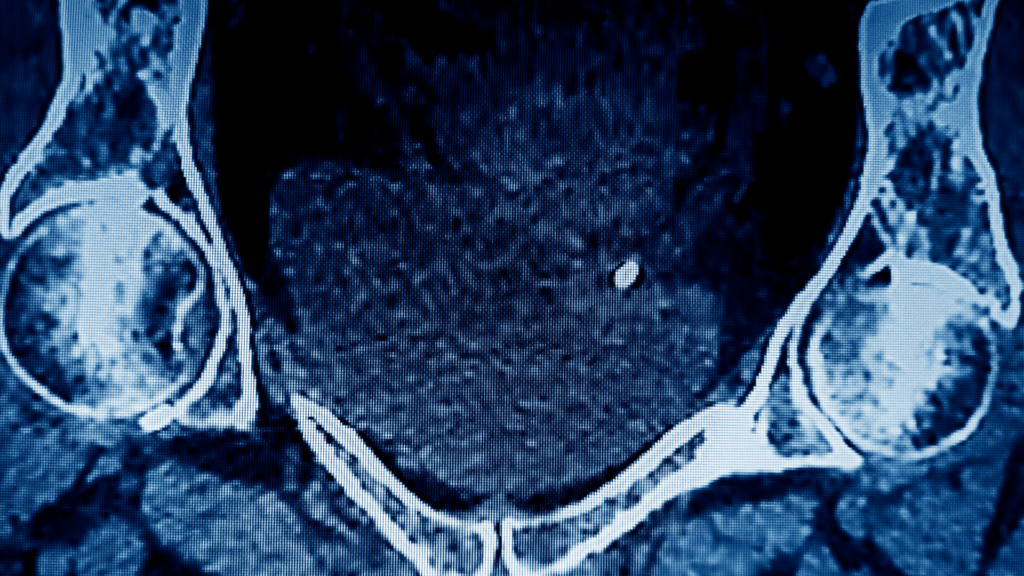 CT scan of kidney stone