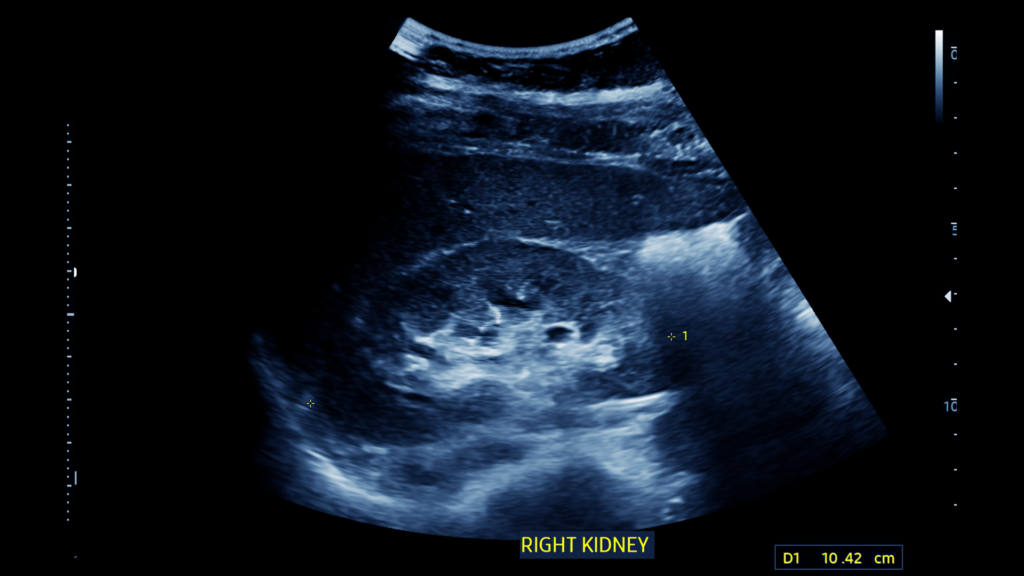 Kidney ultrasound