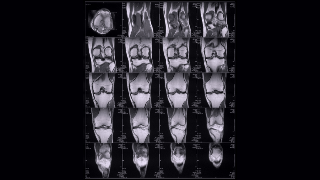 Multiple MRI scans of the knee