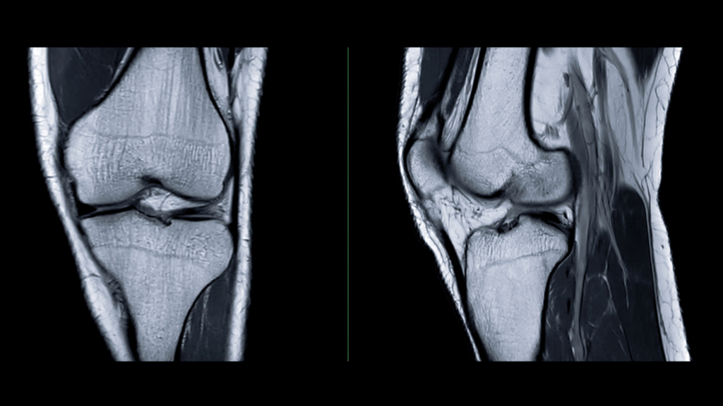 MRI of the knee