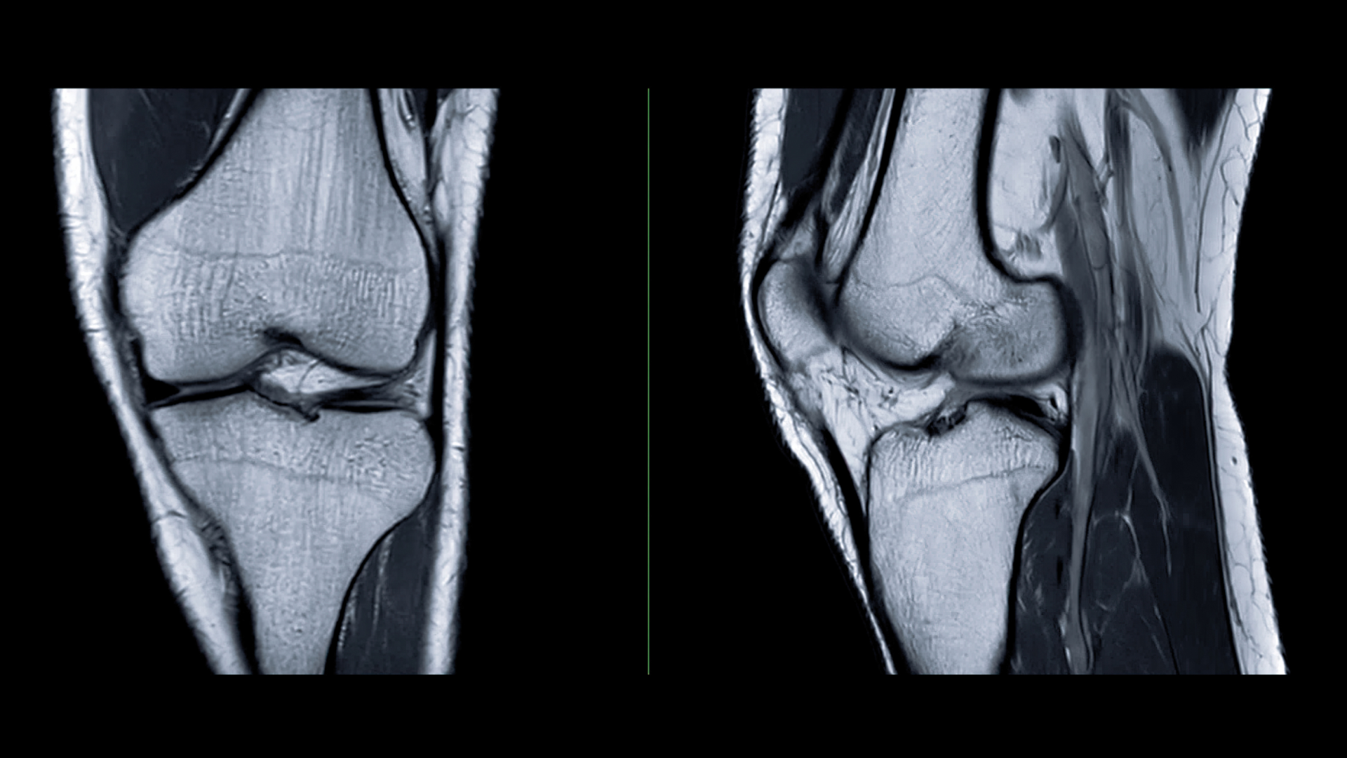 Knee MRI: Preparing for your Appointment and What to Expect