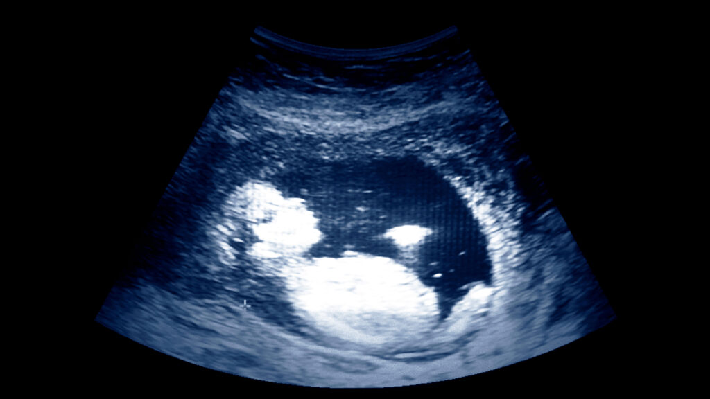 Ultrasound of a 13 week old fetus