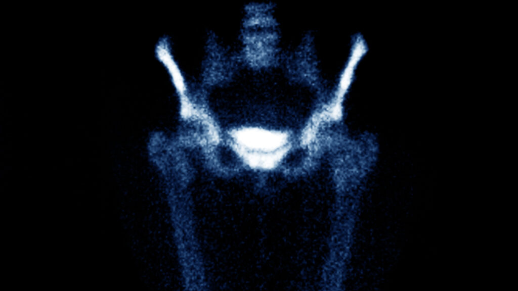 Pelvic bone scan
