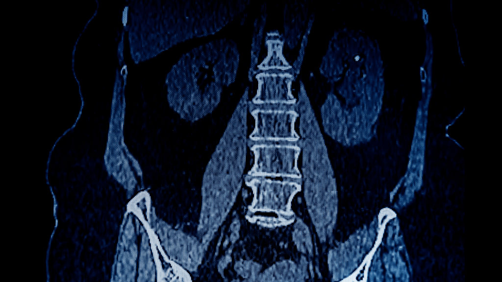 CT scan of kidney stone