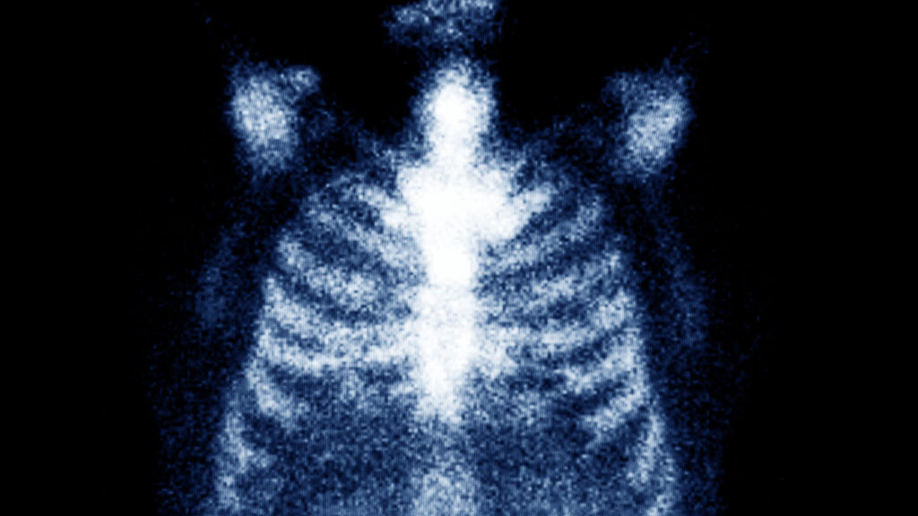 Bone scan of the chest area