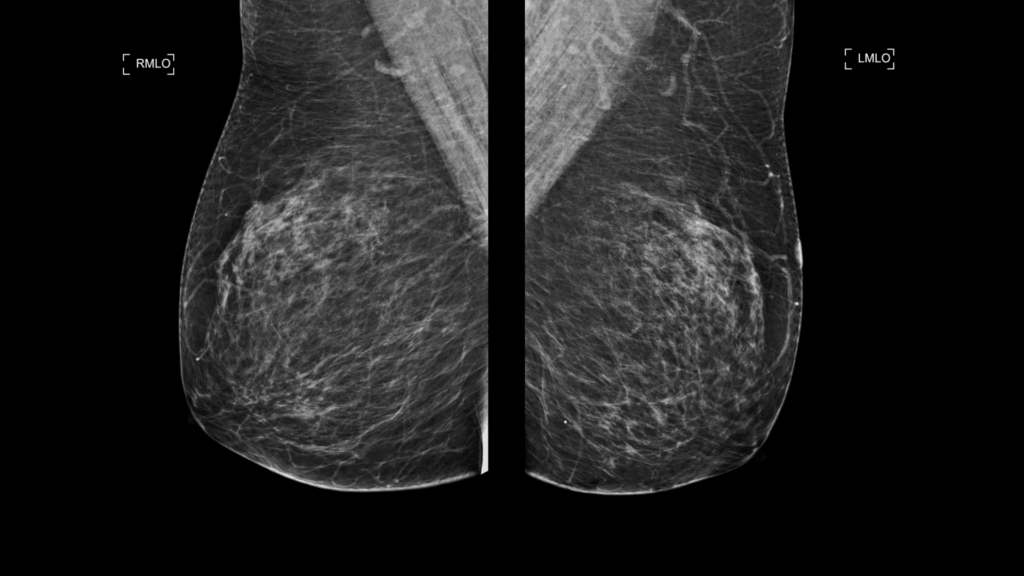 2D mammogram images