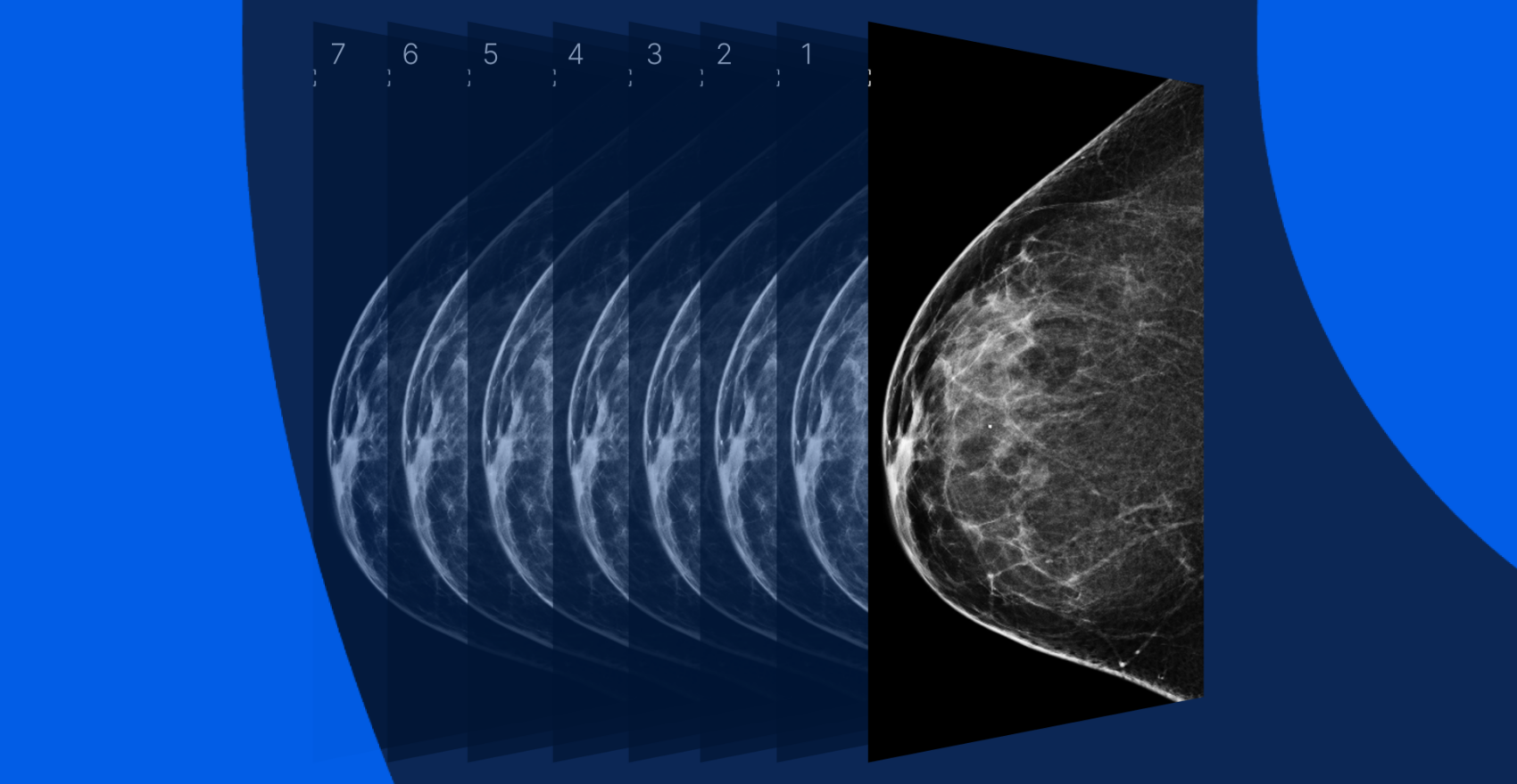 Mammogram