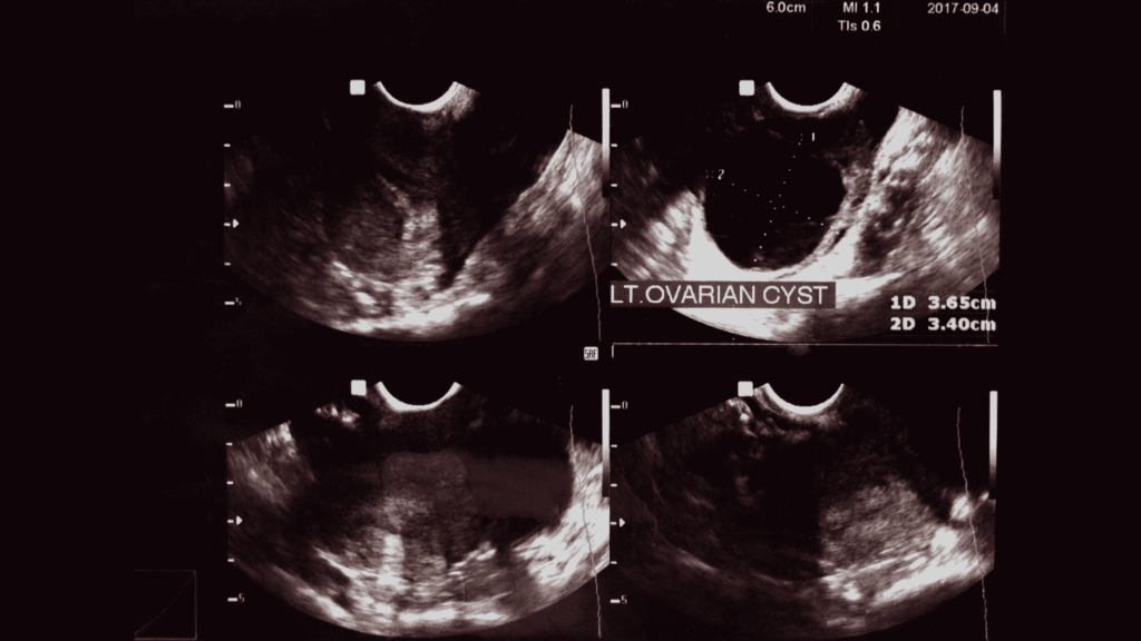 Ultrasound of an ovarian cyst
