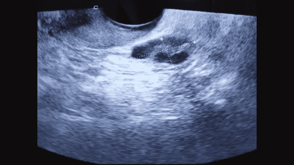 Ultrasound of ovarian follicle