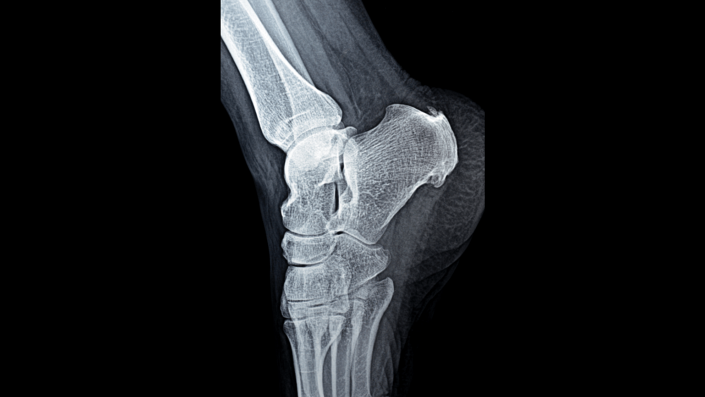 X-ray of a bone spur in a patient’s heel