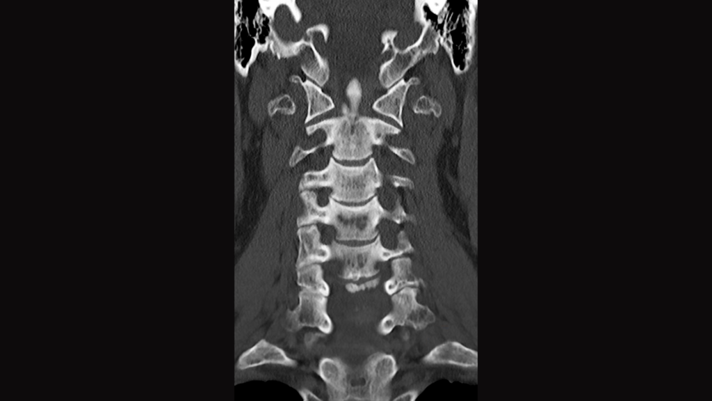 CT scan of a patient’s cervical spine