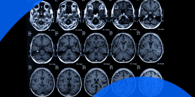 Brain scan