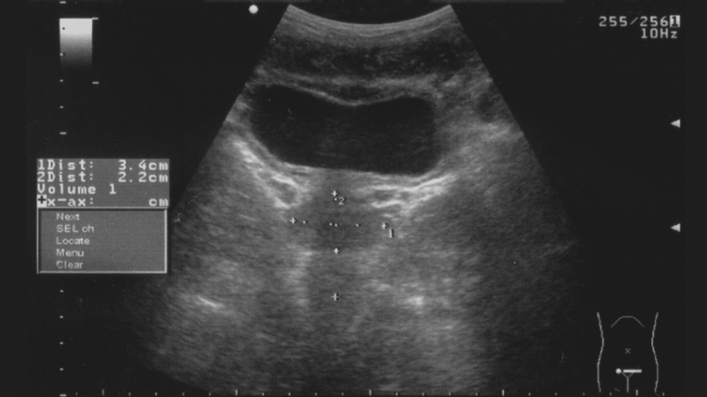 Ultrasound of the bladder and prostate