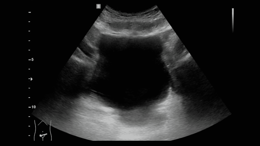 Ultrasound of the bladder