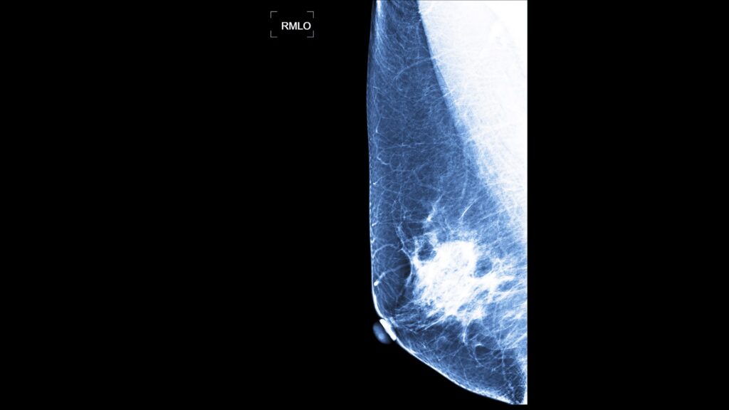 Mammogram showing BI-RADS level two