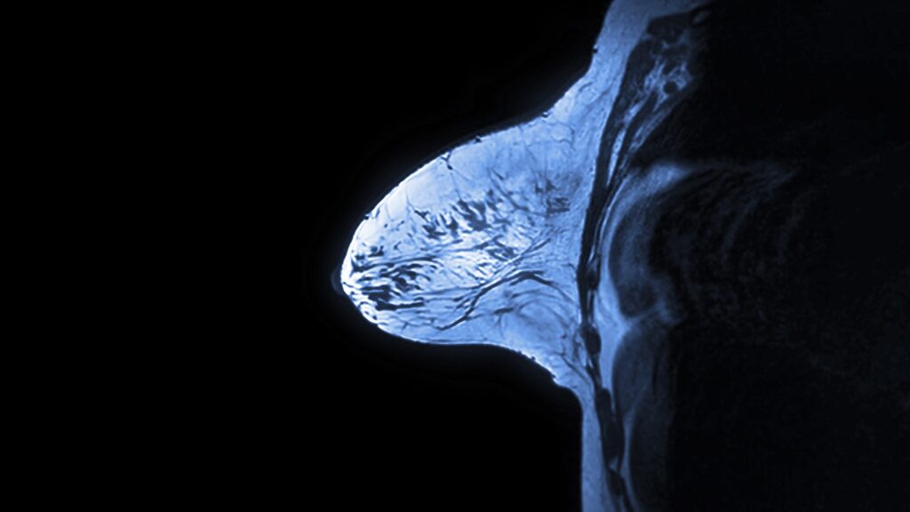 Breast MRI