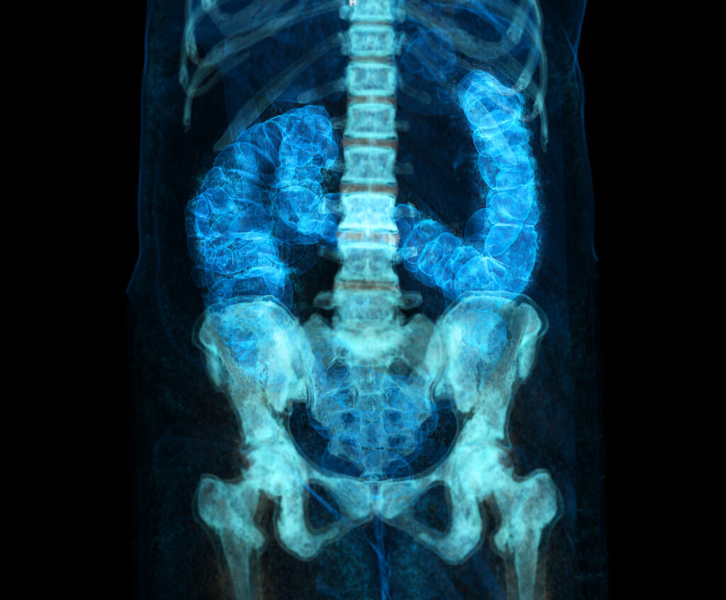 CT scan of a patient’s colon