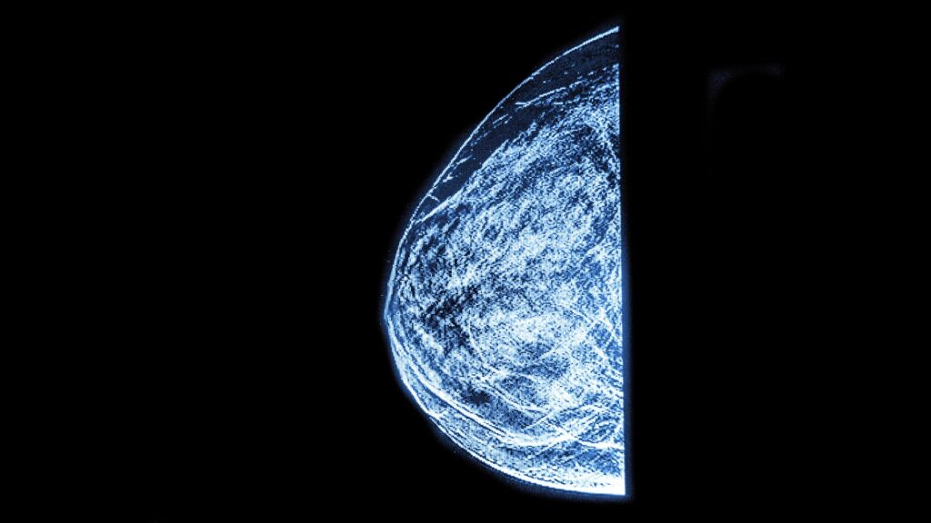 Mammogram scan