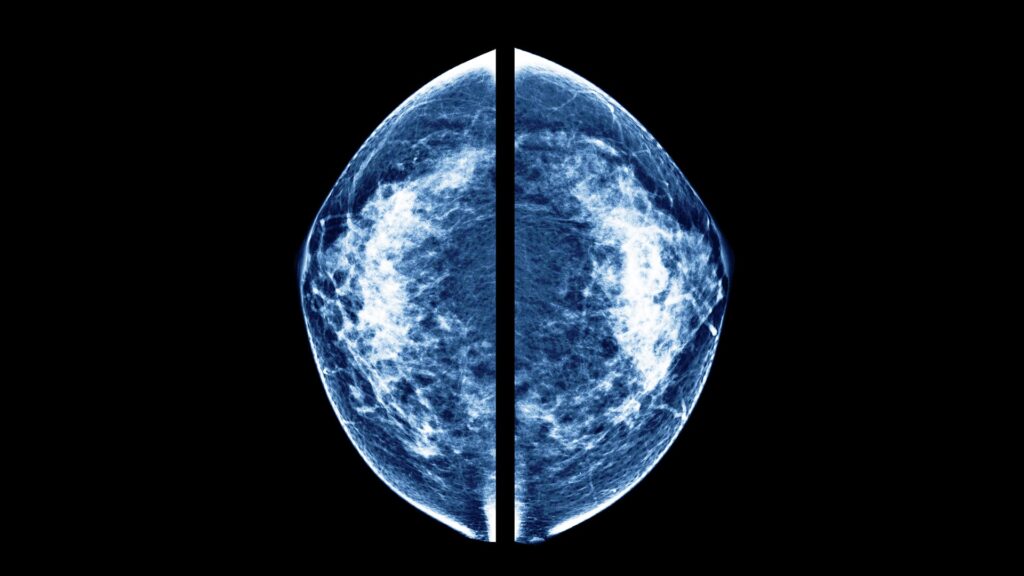 A 2D mammogram