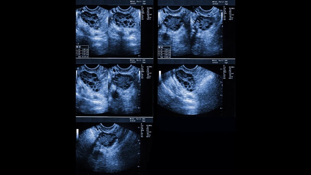 Ultrasound of polycystic ovaries