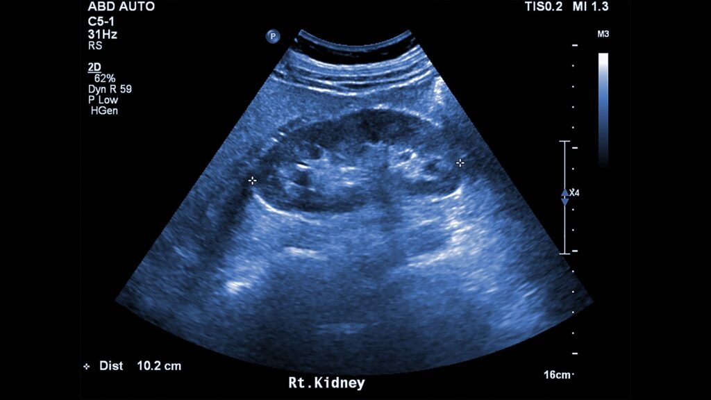 KIDNEY ULTRASOUND