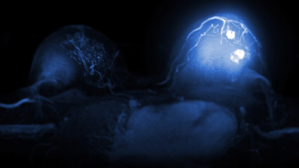 Breast MRI with contrast