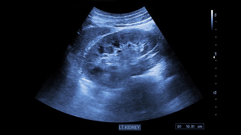 Kidney stone ultrasound