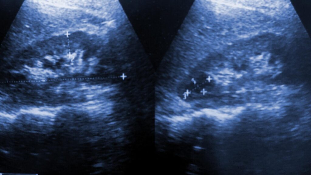 Ultrasound of a kidney cyst