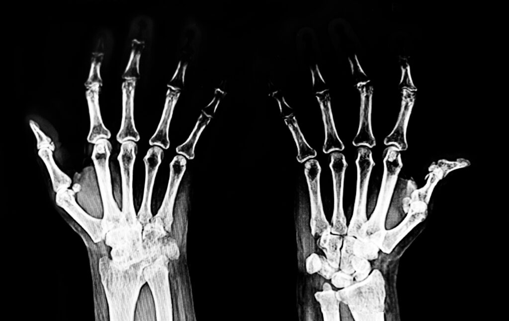  X-ray showing rheumatoid arthritis in the hands