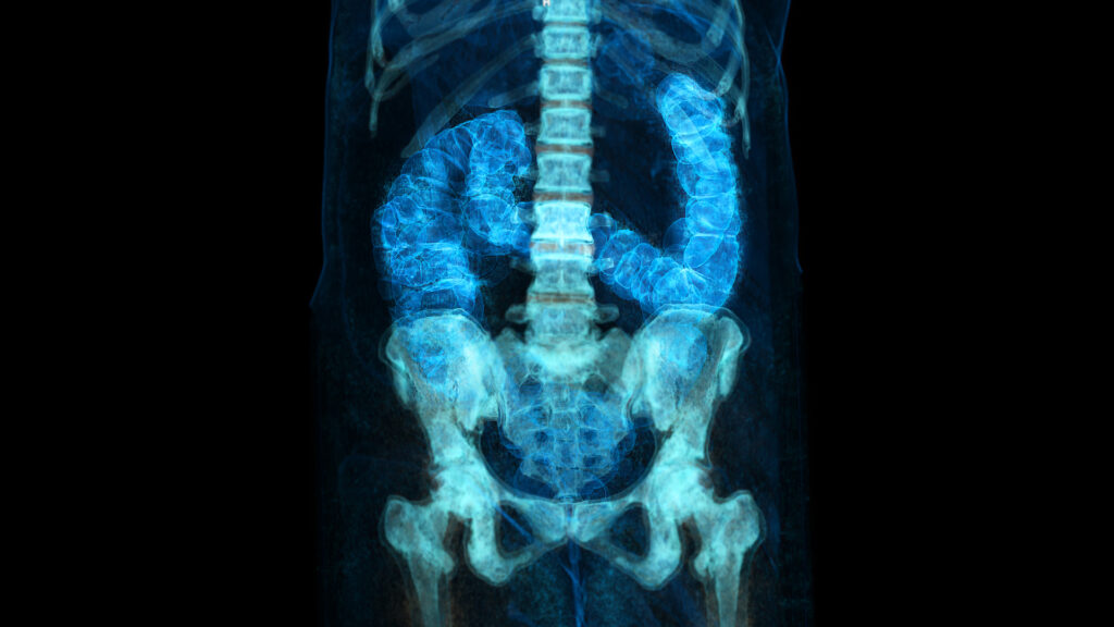 CT scan of a patient’s colon